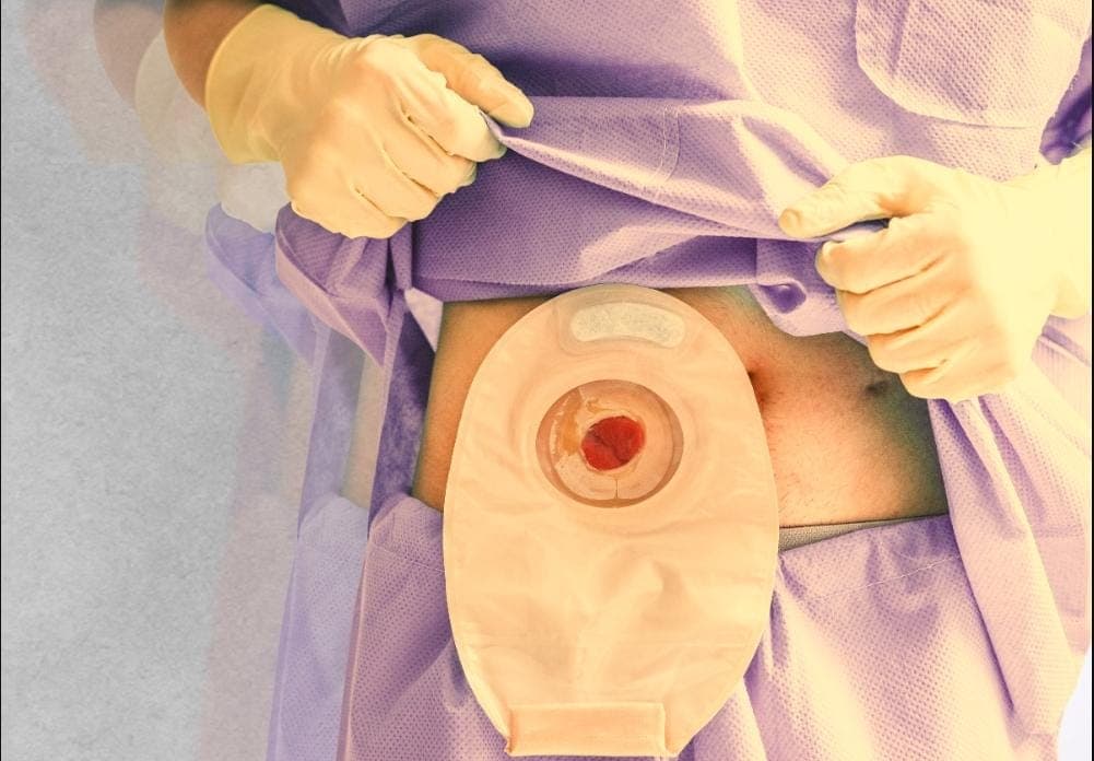 Representative image for Stigma and Stoma: Time to Prescribe Support Beyond Cure